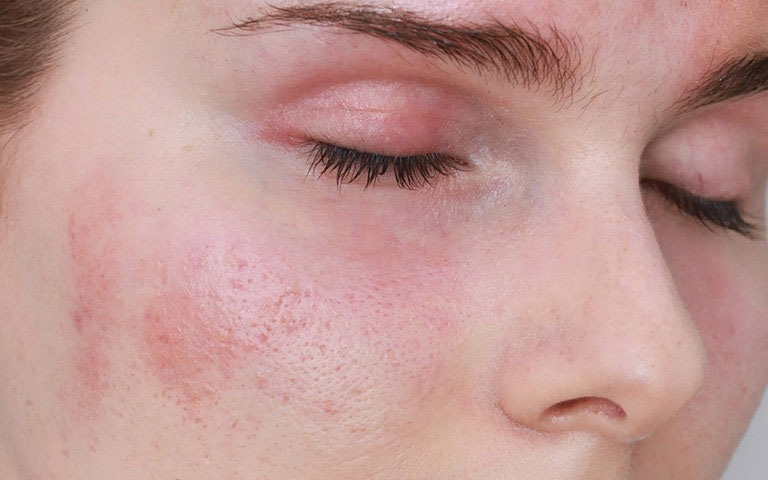 Làm gì khi vùng da quanh mắt bị khô ngứa